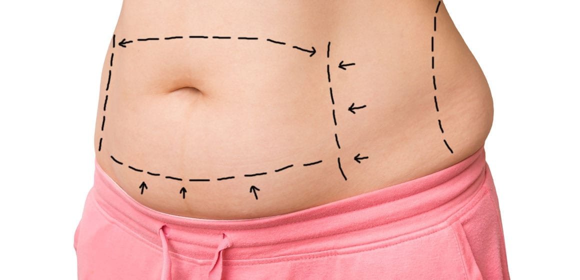 ABDOMINOPLASTY (TUMMY TUCK)